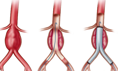 Bóc tách động mạch đốt sống - Hình ảnh minh họa